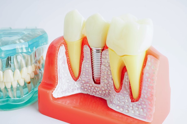 Important Facts To Know About Dental Crowns